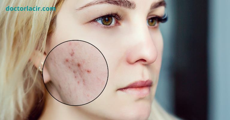 Cách lựa chọn mỹ phẩm cho da mụn