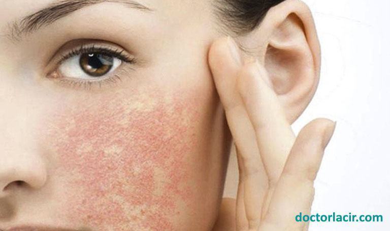 Cách giảm kích ứng cho da bị dị ứng hóa mỹ phẩm
