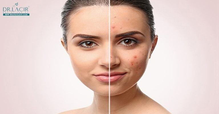 BIẾT ĐƯỢC BÍ QUYẾT LÀM MỜ THÂM NÀY, “SỢ GÌ” THÂM MỤN
